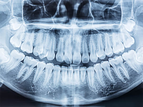 Dental X Rays Dentist Whitehall Montana Dennis Sacry Dental