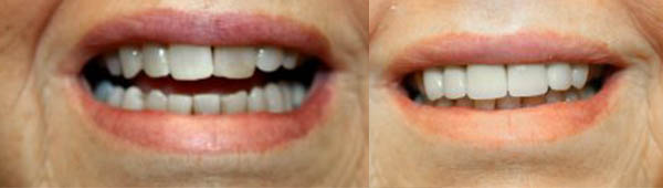Dentist In Whitehall Dental Recovery Before And After Teeth Contouring