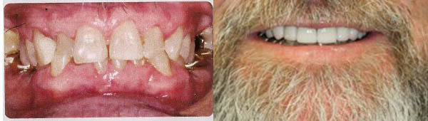 Dentist In Whitehall Dental Recovery Before And After Teeth Straightening