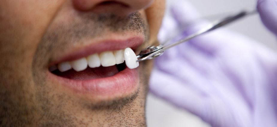 Teeth Veneers Dentist Whitehall Montana Dennis Sacry Dental Page