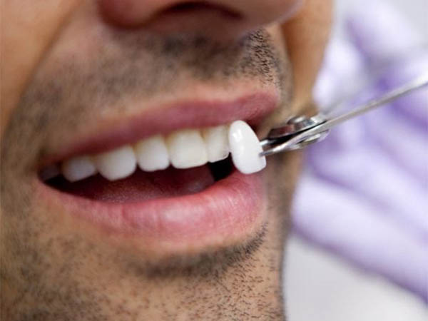 Teeth Veneers Dentist Whitehall Montana Dennis Sacry Dental